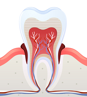 치주염(중기~ 말기)